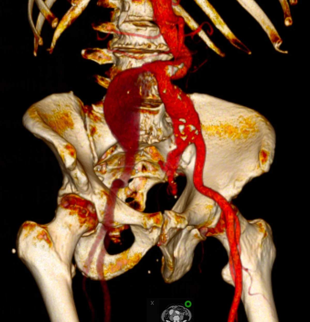 Reconstrução em três dimensões de uma angiotomografia, mostrando a aorta abdominal e as artérias ilíacas